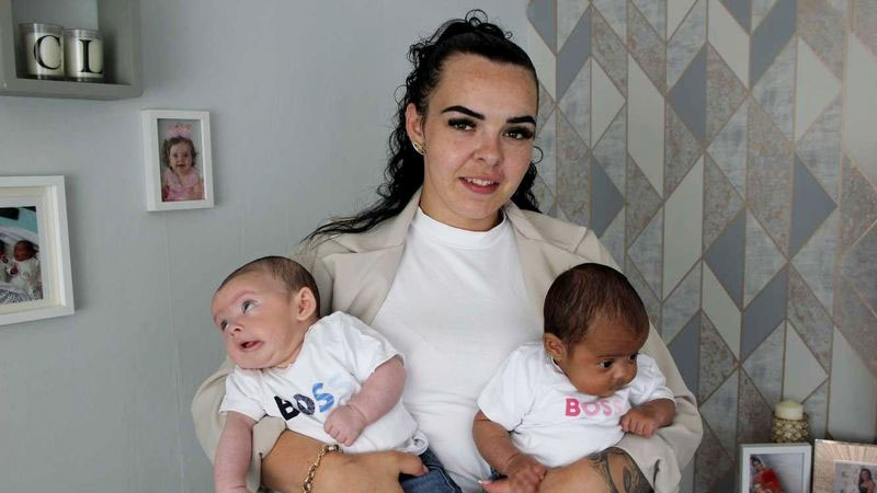  Stunned mother gives birth to million-to-one white and black twins with different skin tones